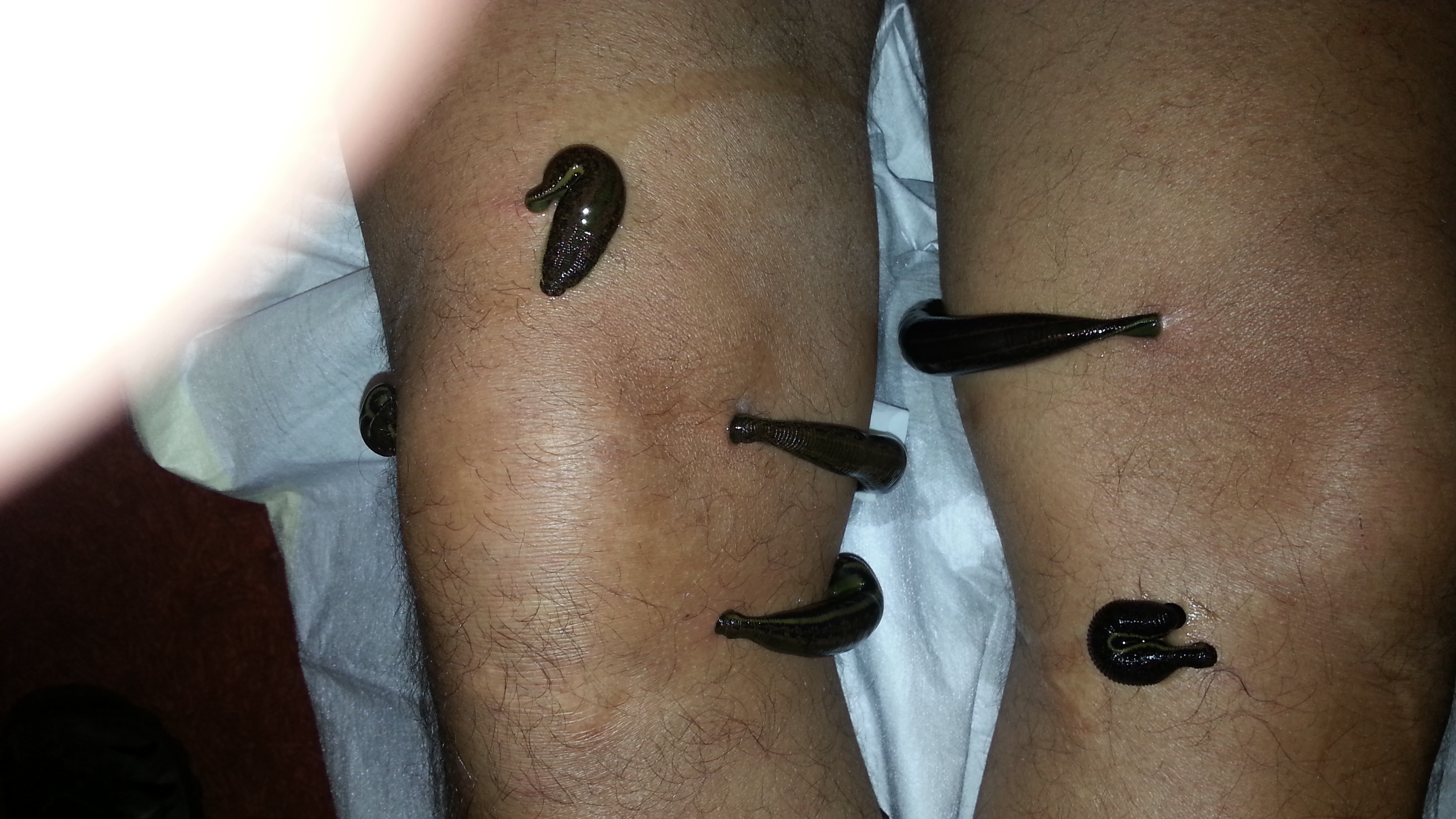Blutegeltherapie